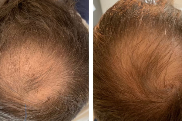 Electrophoresis hair growth Electrophoresis hair growth