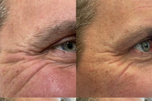 NuVissa - Crow_s Feet B_A NuVissa - Crow_s Feet B_A