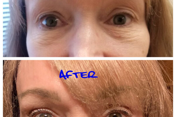 NuVissa Eye Lift B_A after 1 tx NuVissa Eye Lift B_A after 1 tx