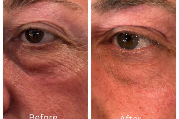 NuVissa Plasma_Electrophoreses lower bleph NuVissa Plasma_Electrophoreses lower bleph