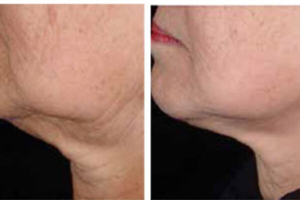 NuVissa Plasma_Electrophoresis Neck Lift after 1 tx NuVissa Plasma_Electrophoresis Neck Lift after 1 tx