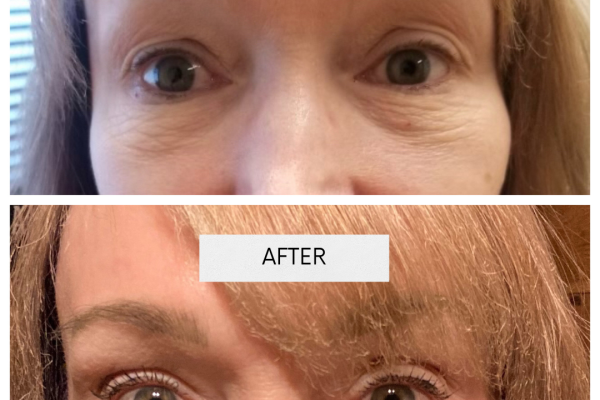 NuVissa Plasma_Electrophoresis upper and lower bleph after tx 1 Nuvissa Plasma Pen